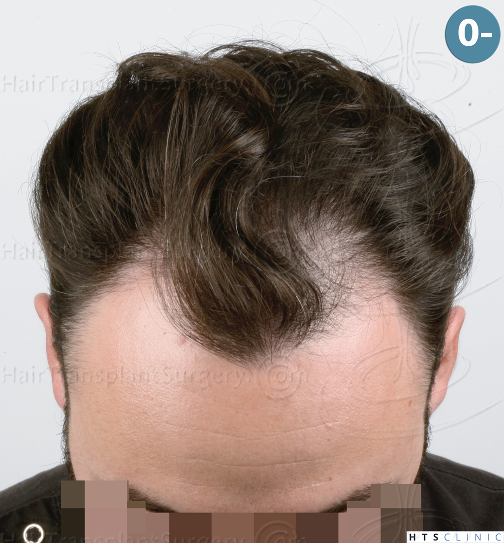 Dr.Devroye-HTS-Clinic-3545-FUE-2