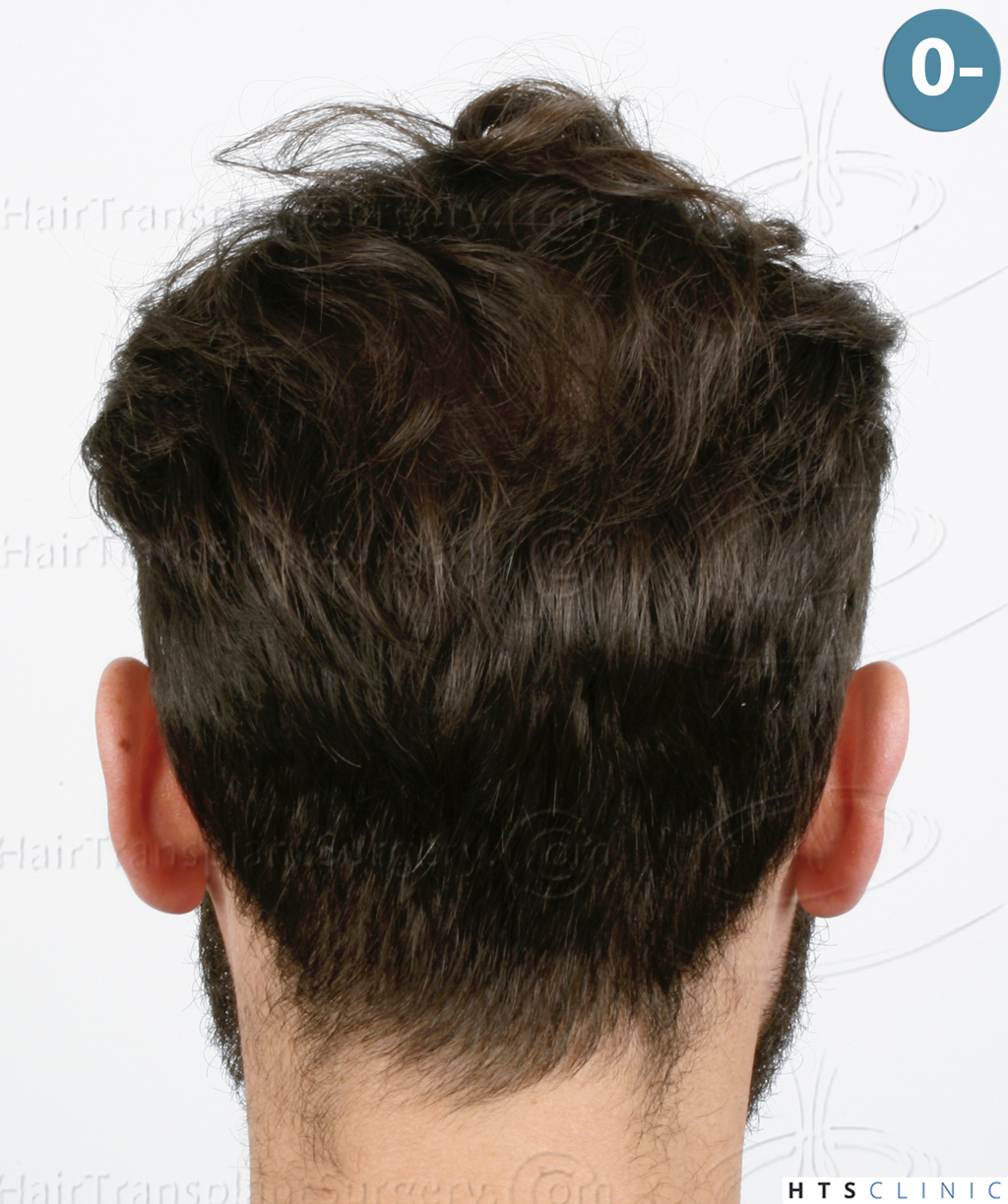 Dr.Devroye-HTS-Clinic-3545-FUE-7