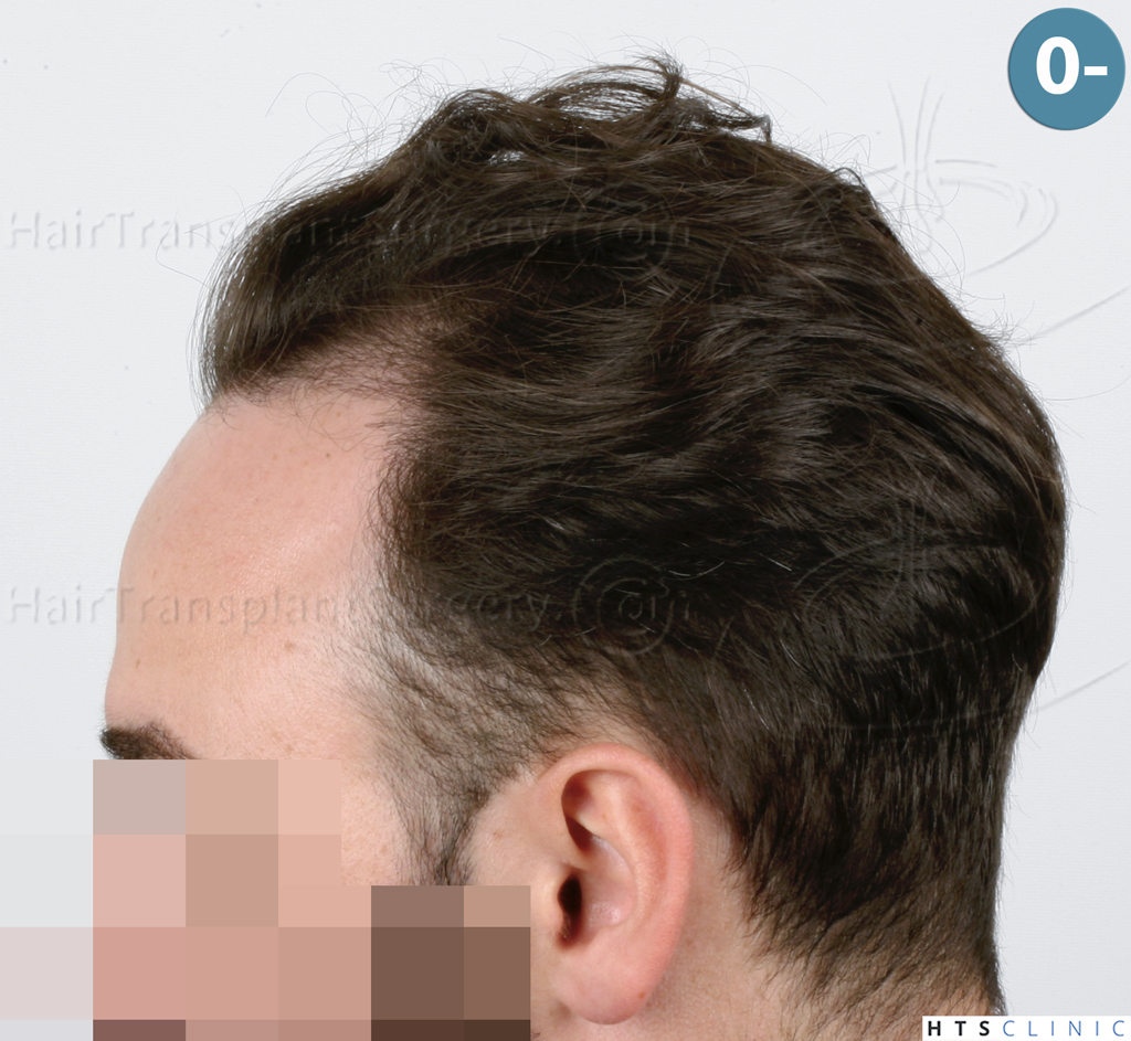 Dr.Devroye-HTS-Clinic-3545-FUE-3