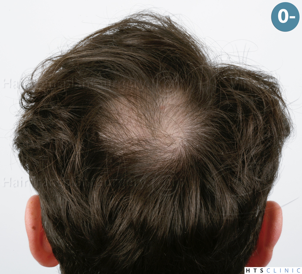 Dr.Devroye-HTS-Clinic-3545-FUE-9