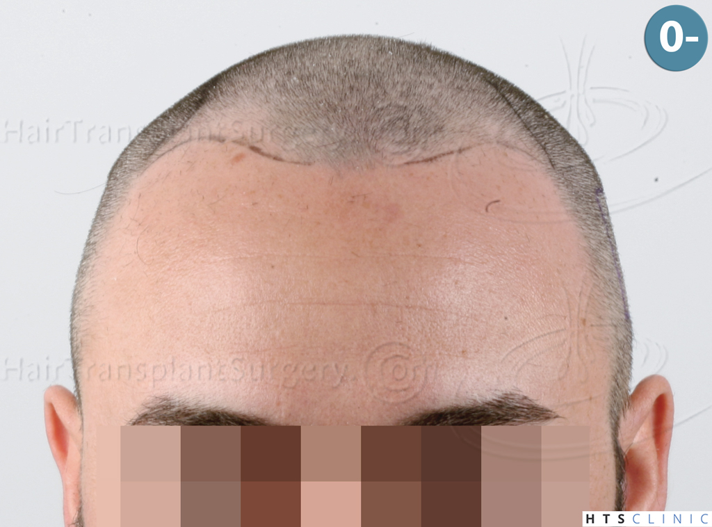 Dr.Devroye-HTS-Clinic-3545-FUE-10