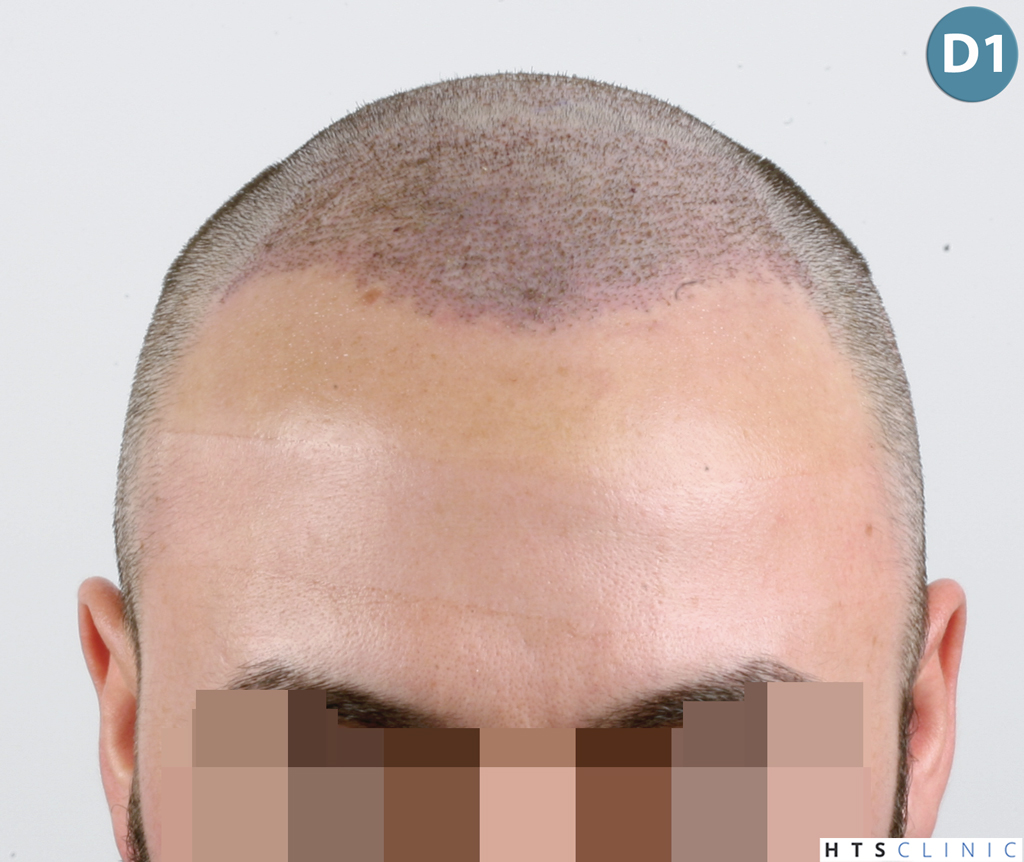 Dr.Devroye-HTS-Clinic-3545-FUE-13