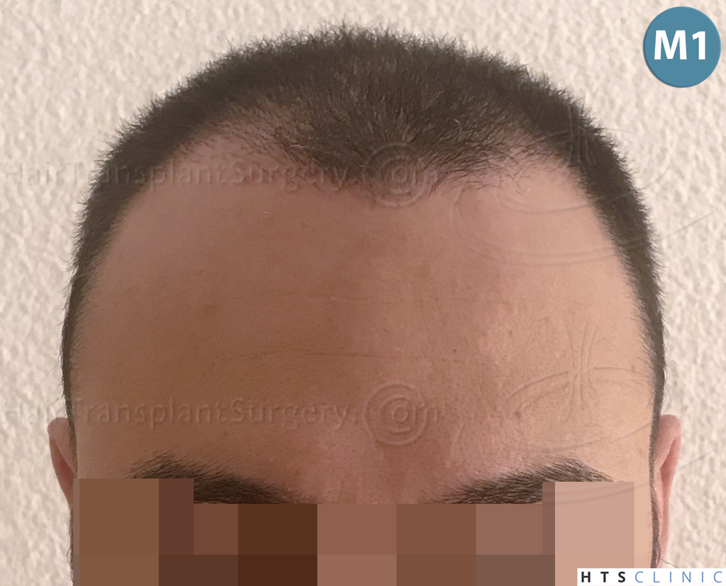 Dr.Devroye-HTS-Clinic-3545-FUE-16