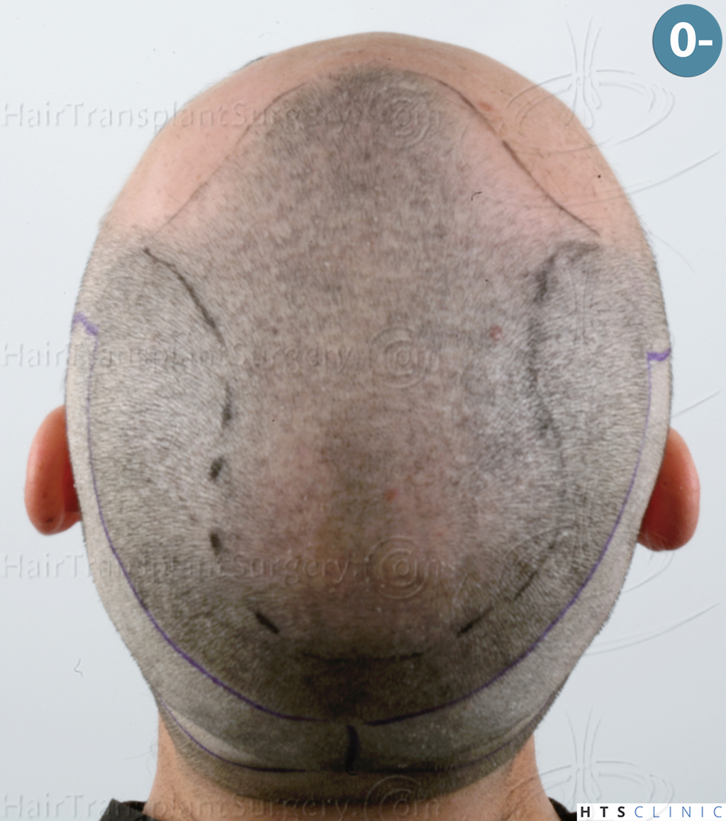 Dr.Devroye-HTS-Clinic-3545-FUE-12