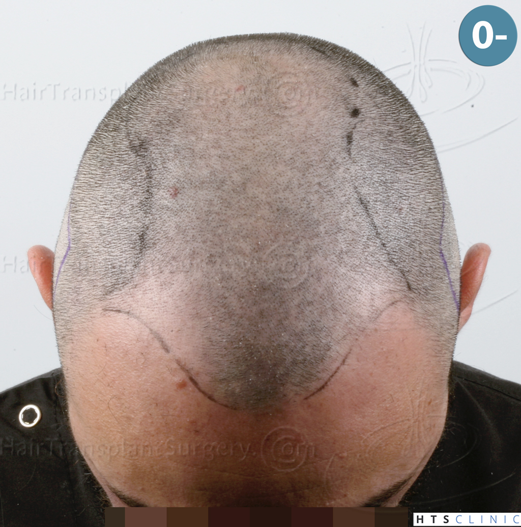 Dr.Devroye-HTS-Clinic-3545-FUE-11