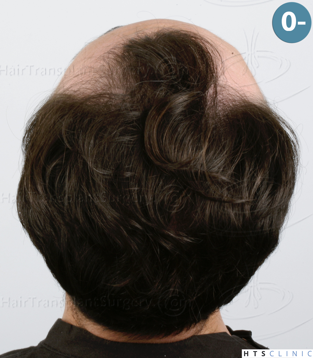 Dr.Devroye-HTS-Clinic-3545-FUE-8