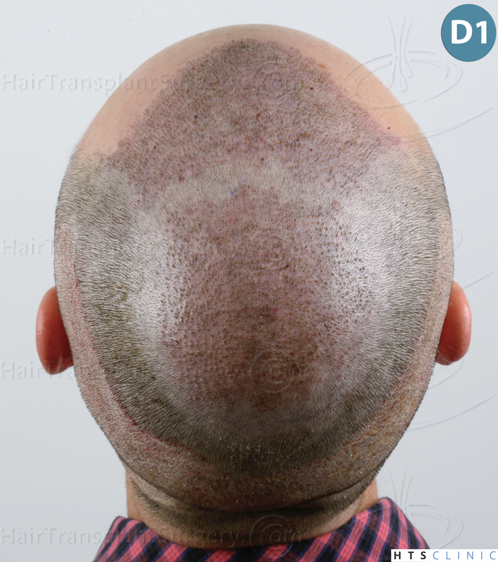 Dr.Devroye-HTS-Clinic-3545-FUE-15