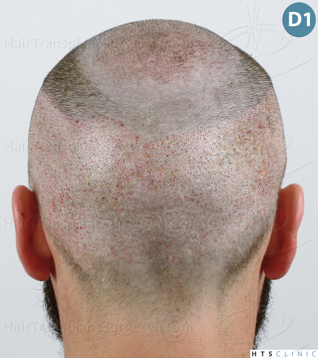 Dr.Devroye-HTS-Clinic-3545-FUE-14