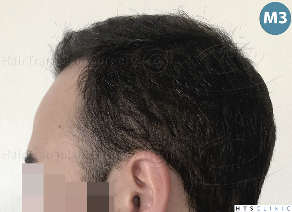 Dr.Devroye-HTS-Clinic-3545-FUE-21