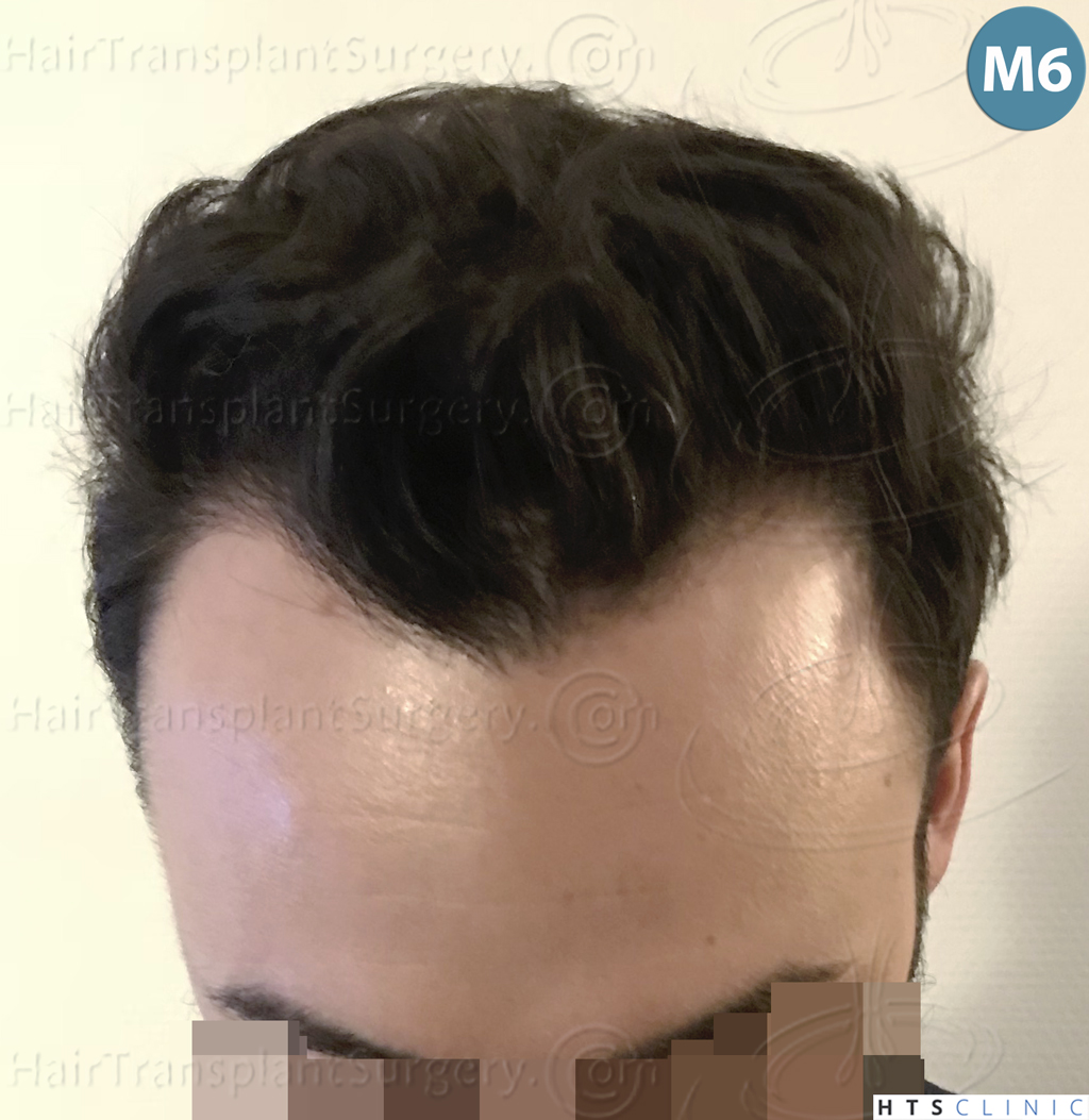 Dr.Devroye-HTS-Clinic-3545-FUE-25