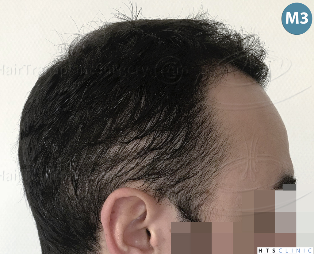 Dr.Devroye-HTS-Clinic-3545-FUE-22