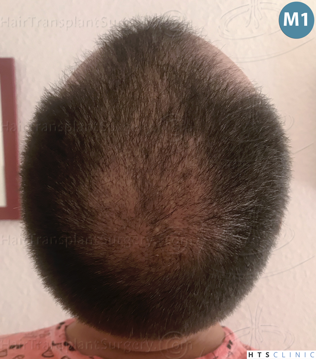 Dr.Devroye-HTS-Clinic-3545-FUE-19