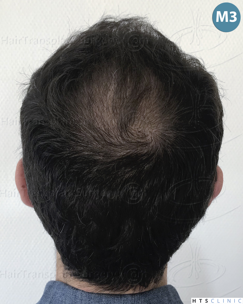 Dr.Devroye-HTS-Clinic-3545-FUE-23