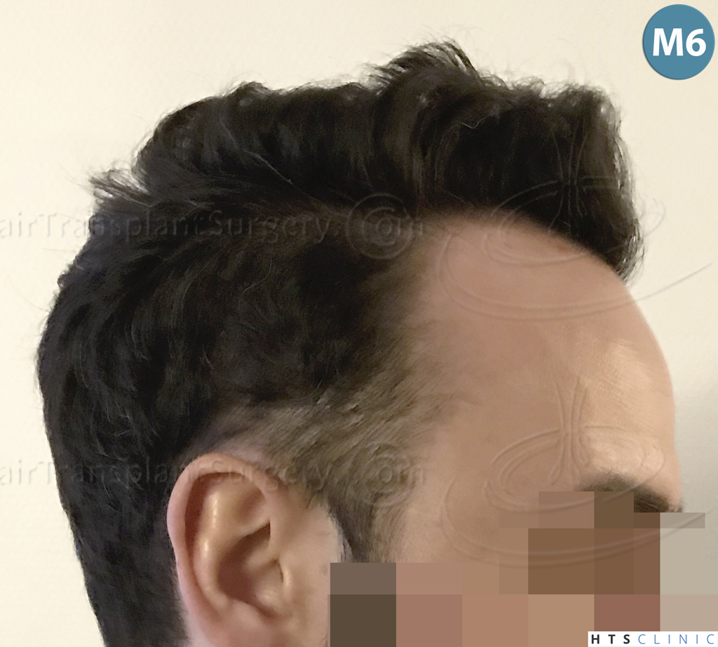 Dr.Devroye-HTS-Clinic-3545-FUE-27