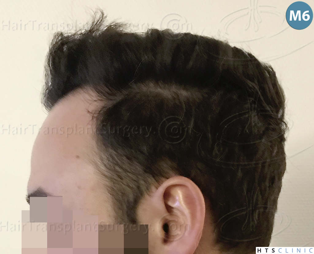 Dr.Devroye-HTS-Clinic-3545-FUE-26