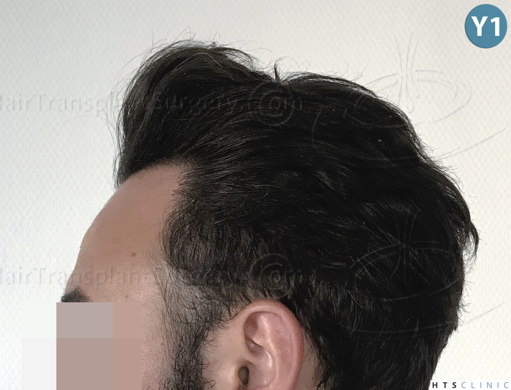 Dr.Devroye-HTS-Clinic-3545-FUE-32