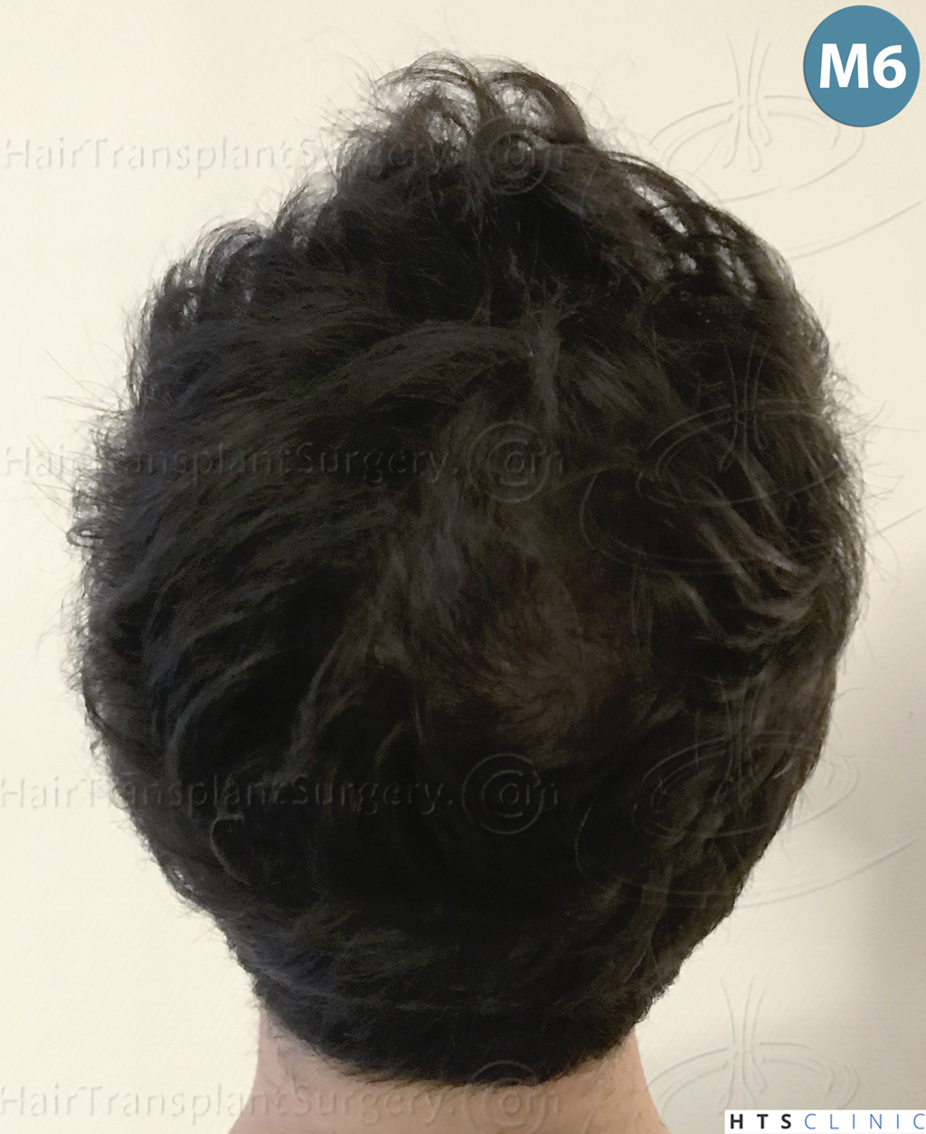 Dr.Devroye-HTS-Clinic-3545-FUE-29