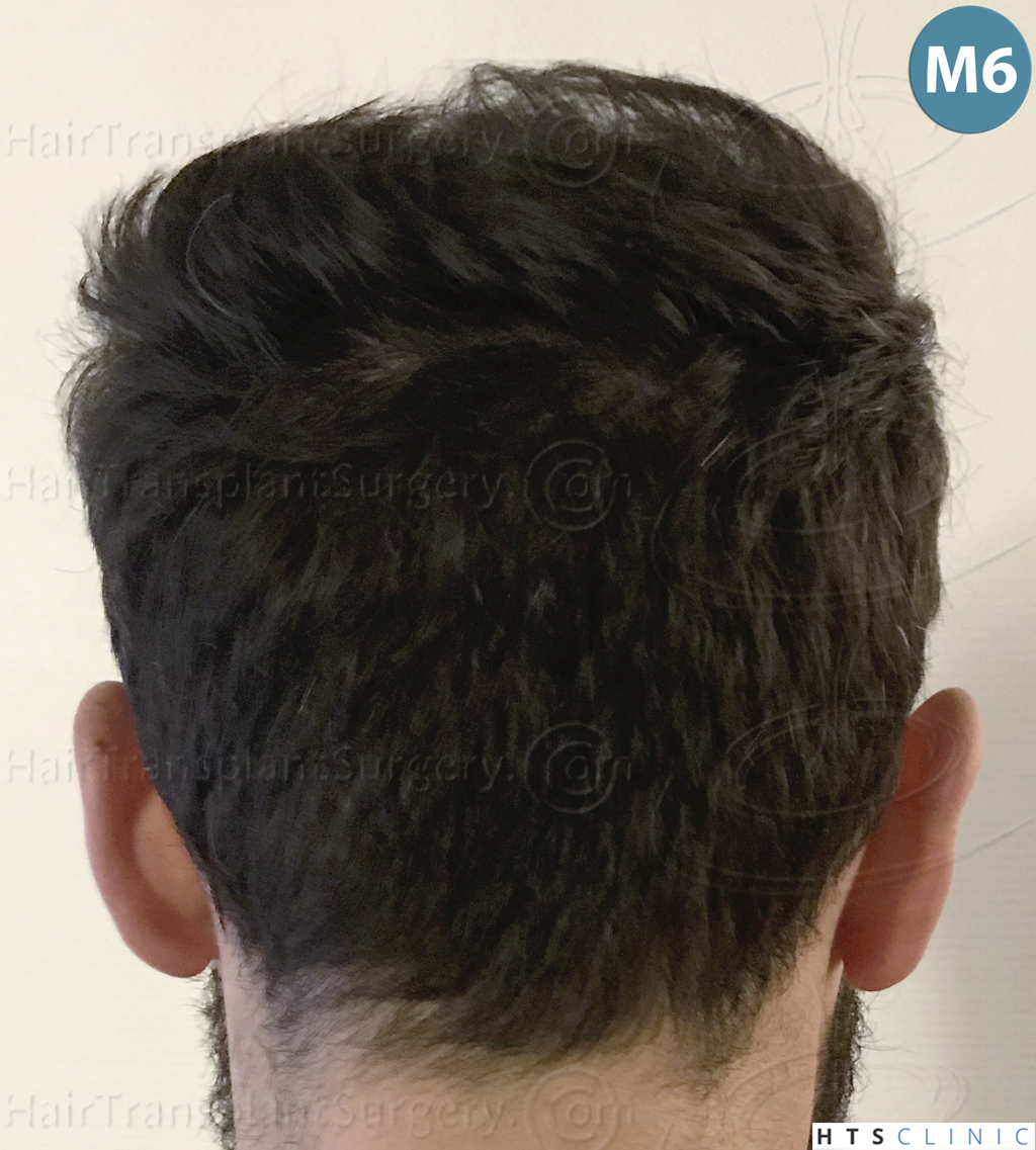 Dr.Devroye-HTS-Clinic-3545-FUE-28