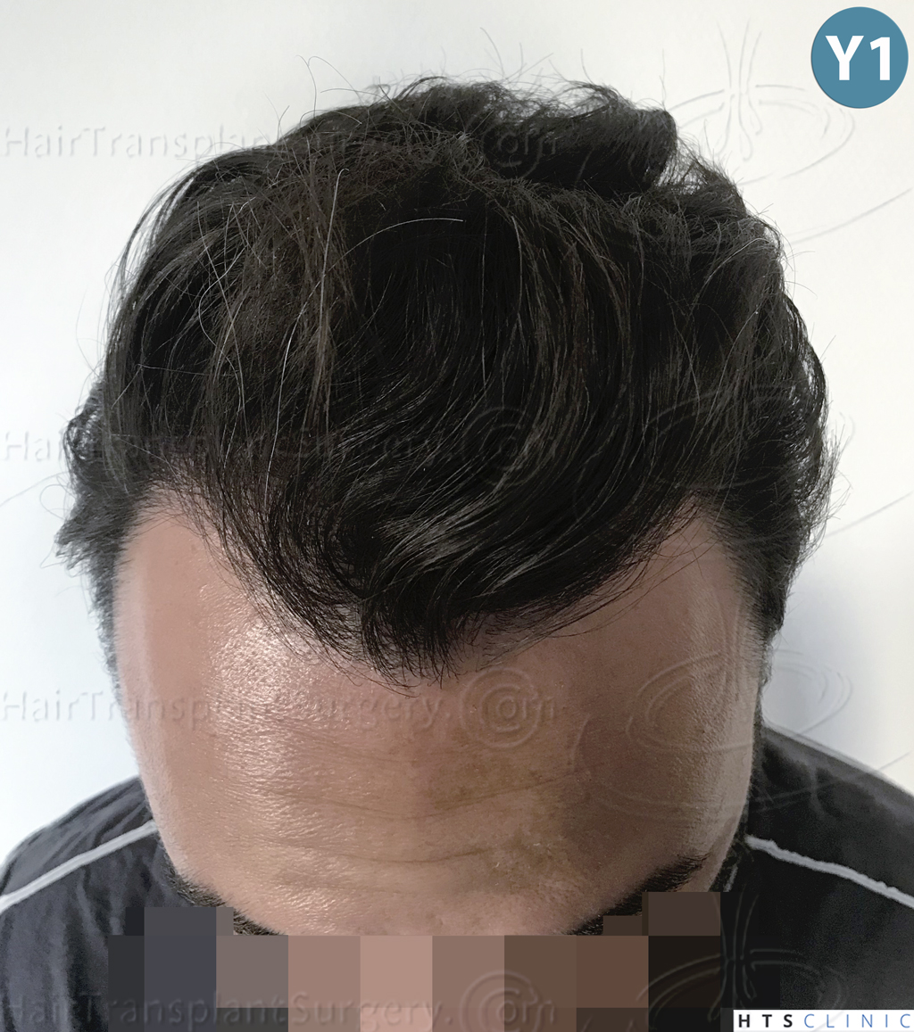 Dr.Devroye-HTS-Clinic-3545-FUE-31