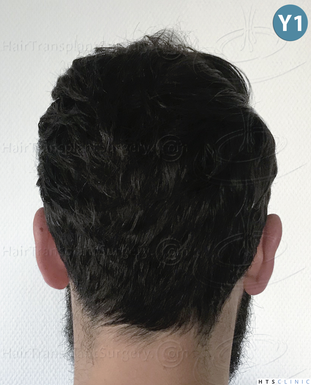 Dr.Devroye-HTS-Clinic-3545-FUE-34