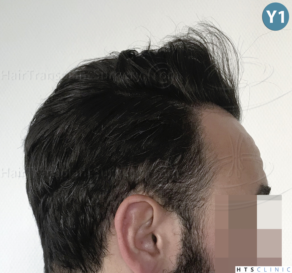 Dr.Devroye-HTS-Clinic-3545-FUE-33