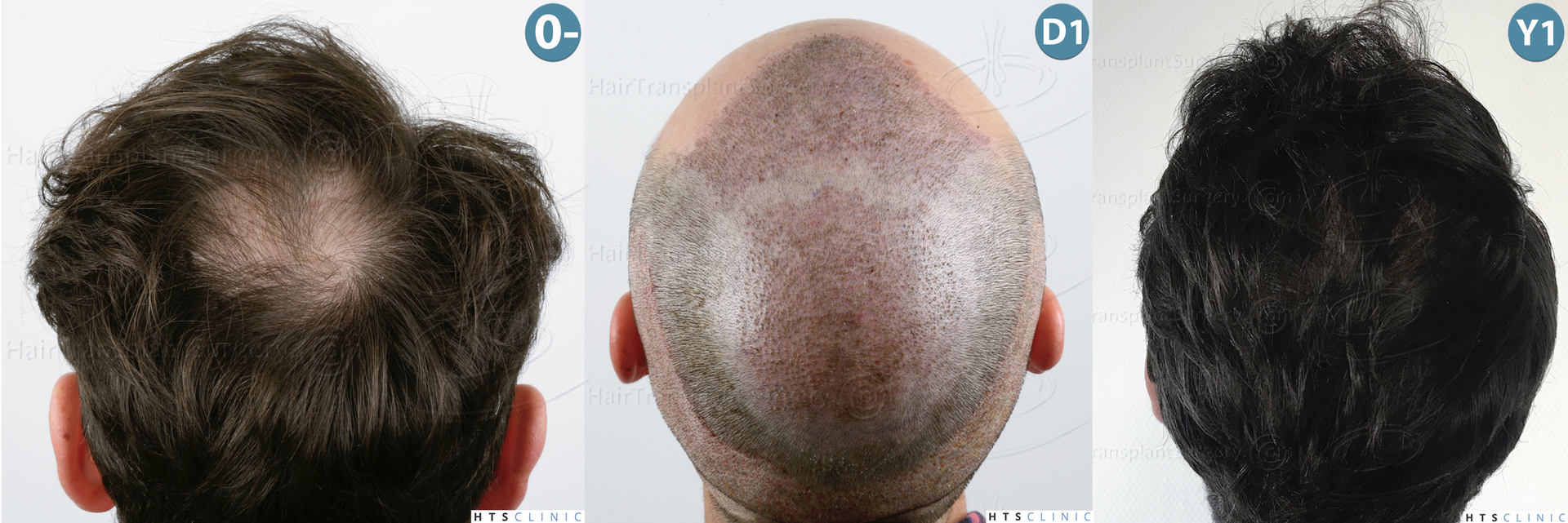 Dr.Devroye-HTS-Clinic-3545-FUE-Montage-3