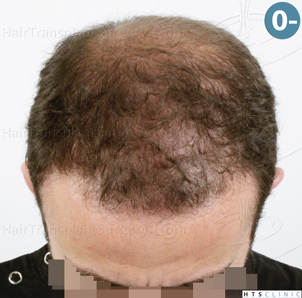 Dr.Devroye-HTS-Clinic-6326-FUE-_4261_206