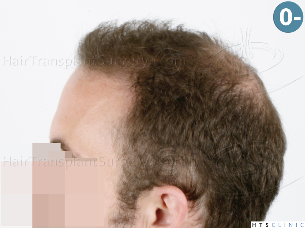 Dr.Devroye-HTS-Clinic-6326-FUE-_4261_206