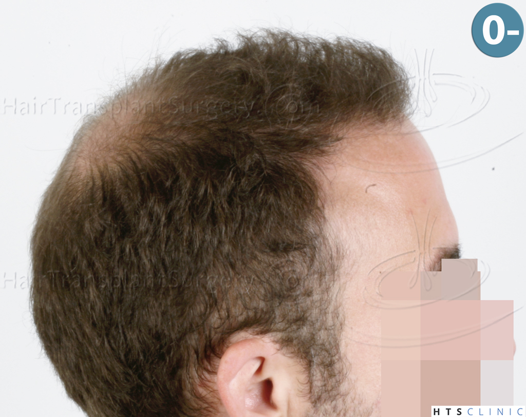 Dr.Devroye-HTS-Clinic-6326-FUE-_4261_2065_-5.jpg
