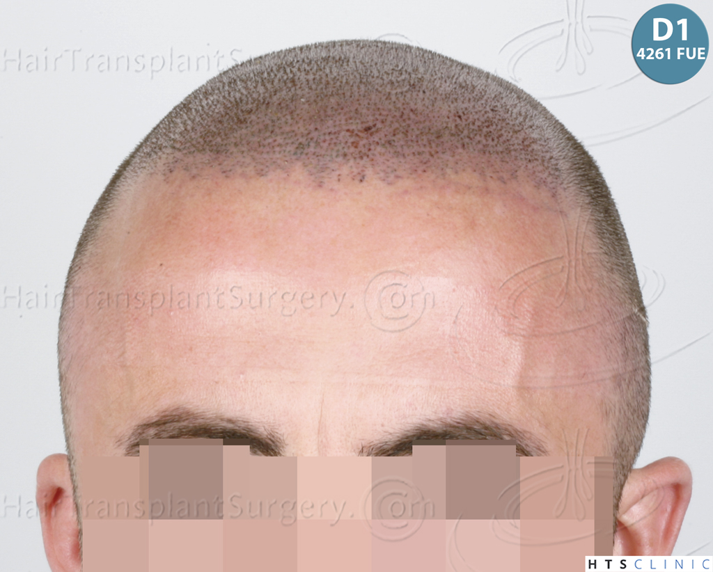 Dr.Devroye-HTS-Clinic-6326-FUE-_4261_206