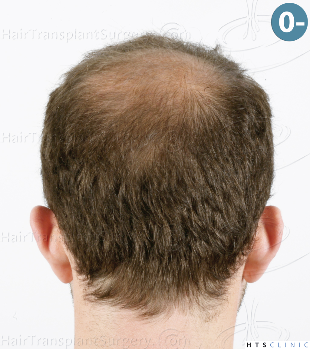 Dr.Devroye-HTS-Clinic-6326-FUE-_4261_206