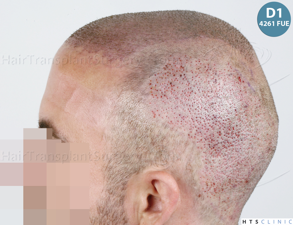 Dr.Devroye-HTS-Clinic-6326-FUE-_4261_206