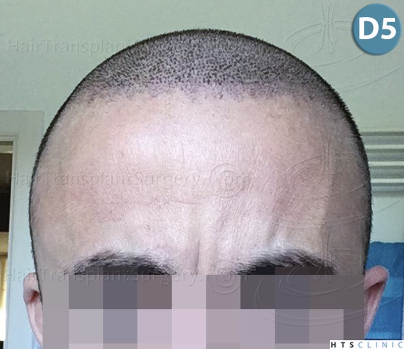 Dr.Devroye-HTS-Clinic-6326-FUE-_4261_206