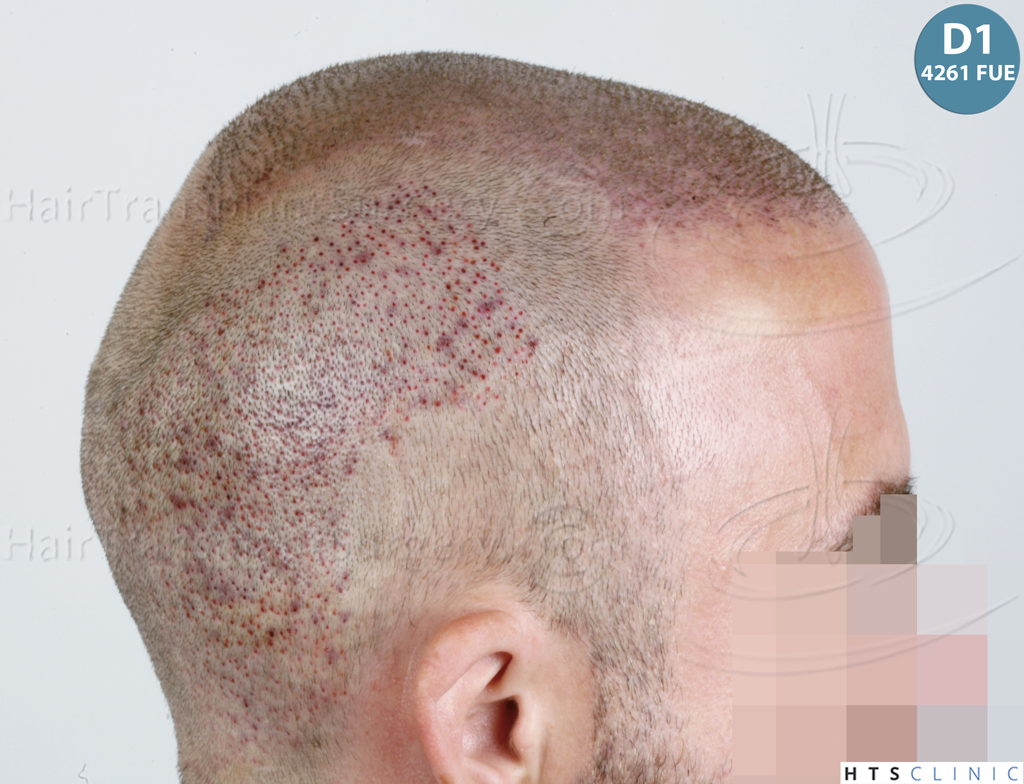 Dr.Devroye-HTS-Clinic-6326-FUE-_4261_206