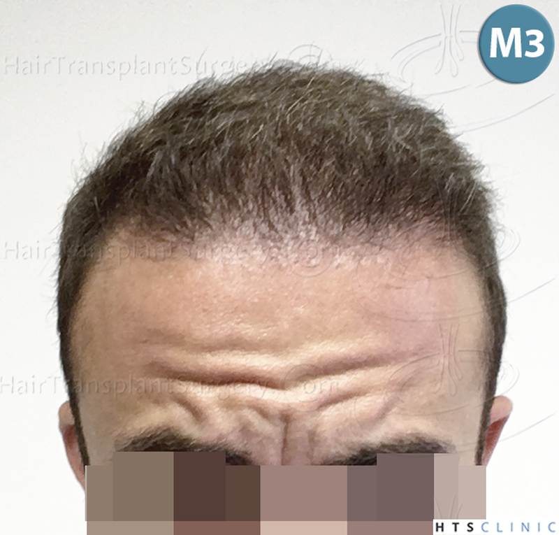 Dr.Devroye-HTS-Clinic-6326-FUE-_4261_206