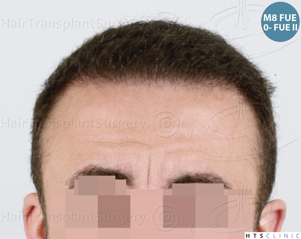 Dr.Devroye-HTS-Clinic-6326-FUE-_4261_206