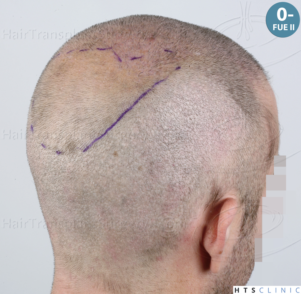 Dr.Devroye-HTS-Clinic-6326-FUE-_4261_206