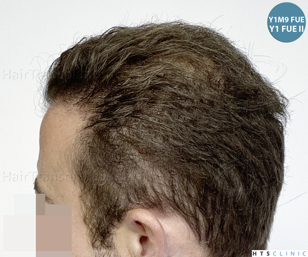 Dr.Devroye-HTS-Clinic-6326-FUE-_4261_206