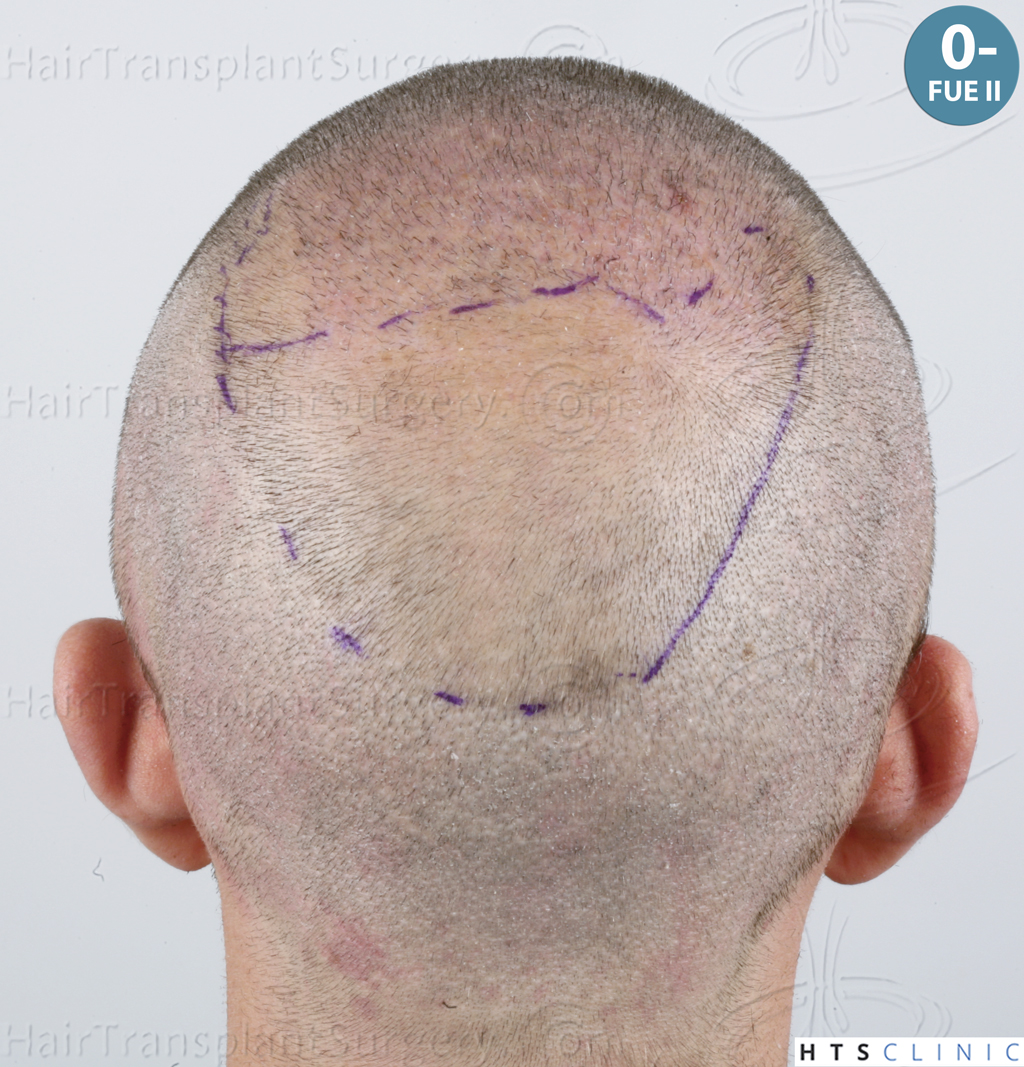 Dr.Devroye-HTS-Clinic-6326-FUE-_4261_206