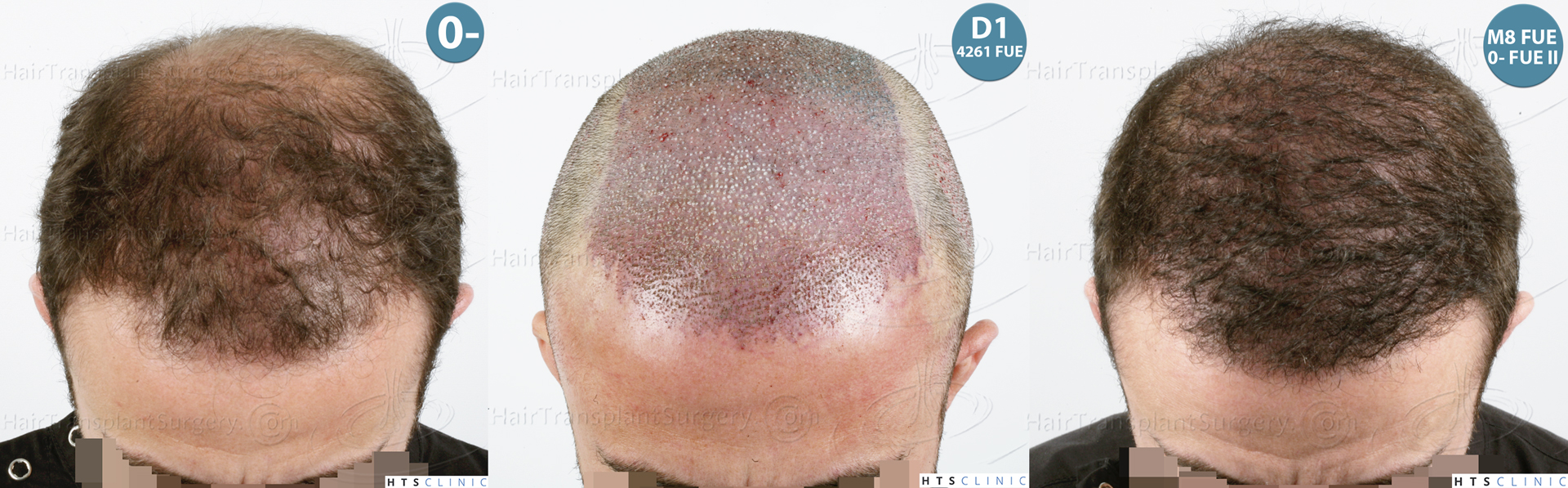 Dr.Devroye-HTS-Clinic-6326-FUE-_4261_206