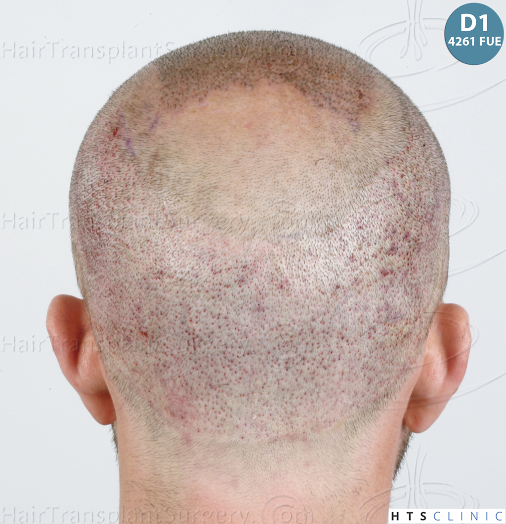 Dr.Devroye-HTS-Clinic-6326-FUE-_4261_206