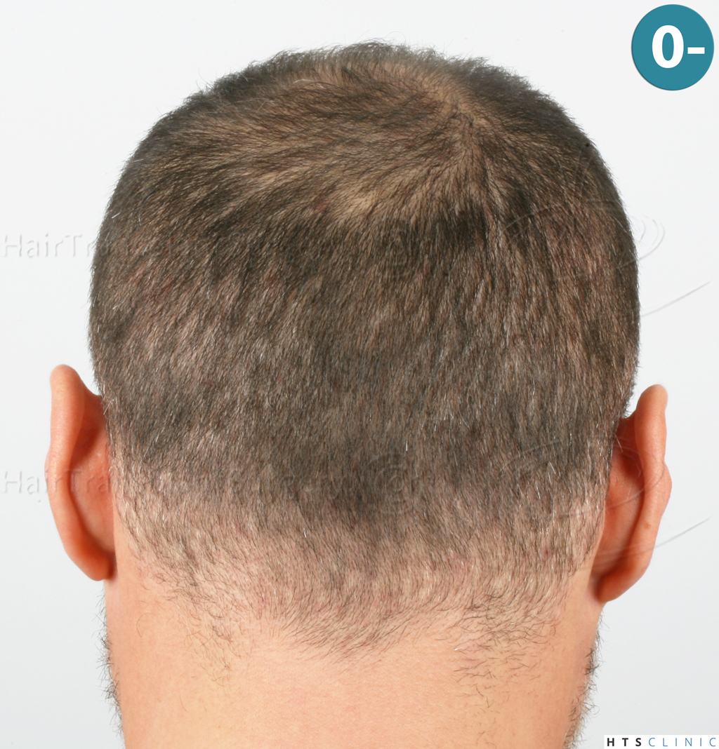 Dr.Devroye-HTS-Clinic-3654_2132-FUE-5.jp