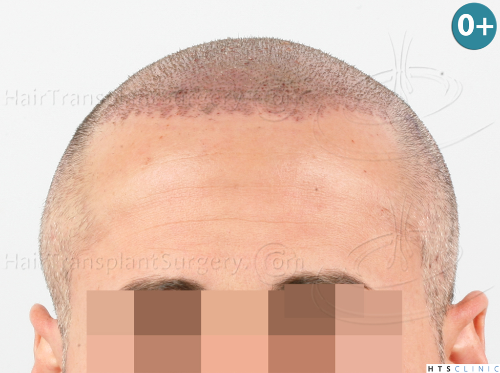 Dr.Devroye-HTS-Clinic-3654_2132-FUE-7.jp