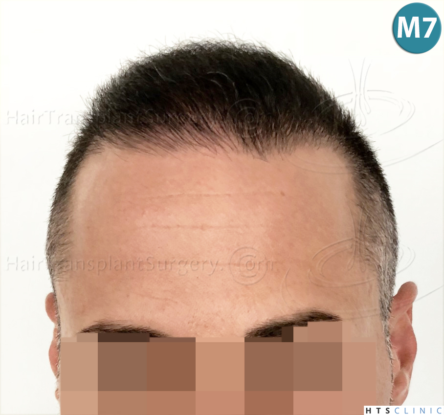 Dr.Devroye-HTS-Clinic-3654_2132-FUE-12.jpg