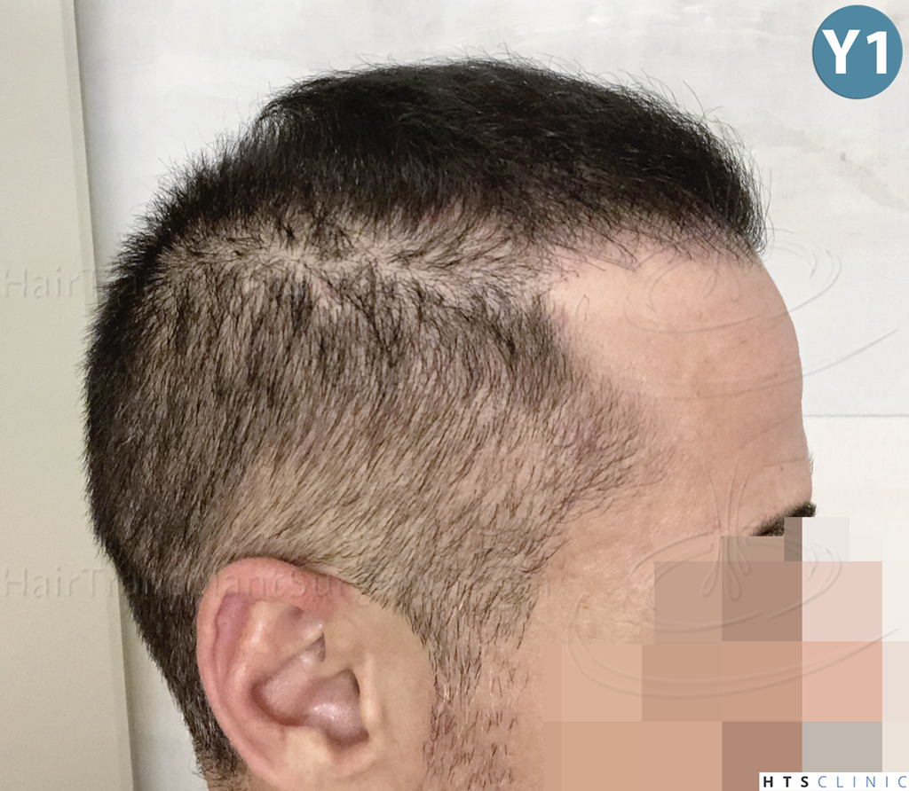 Dr.Devroye-HTS-Clinic-3654_2132-FUE-22.j