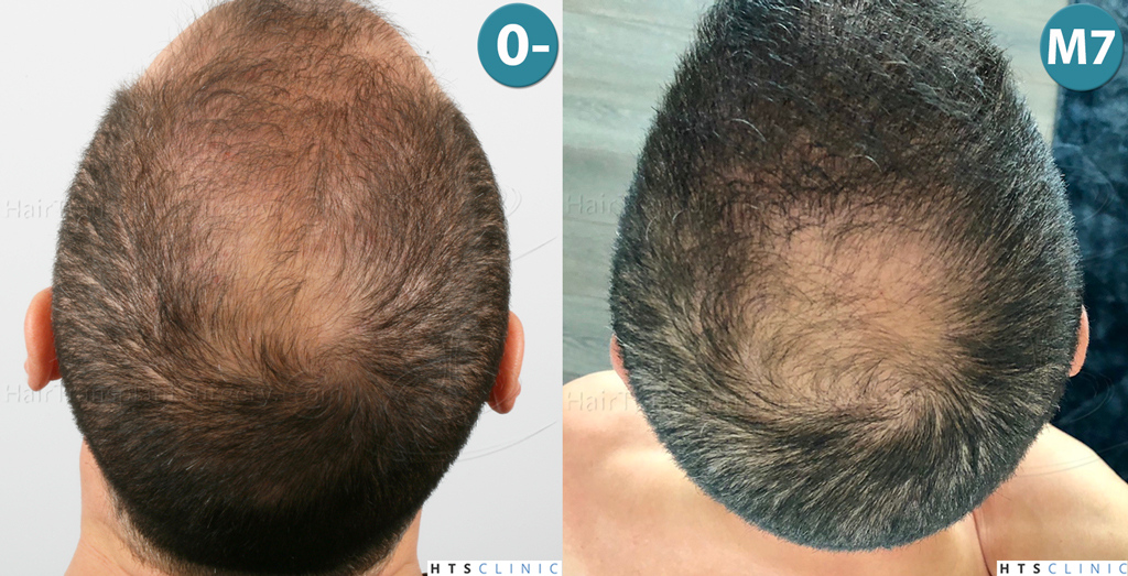 Dr.Devroye-HTS-Clinic-3654_2132-FUE-Mont