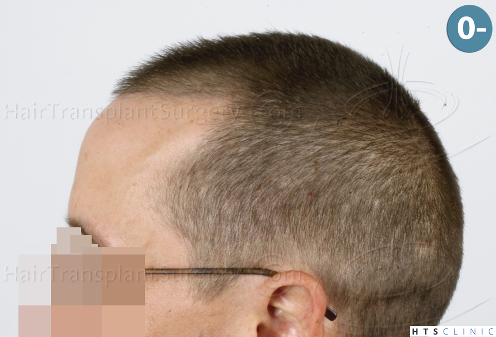 Dr.Devroye-HTS-Clinic-2950-FUE-NW-III-2.