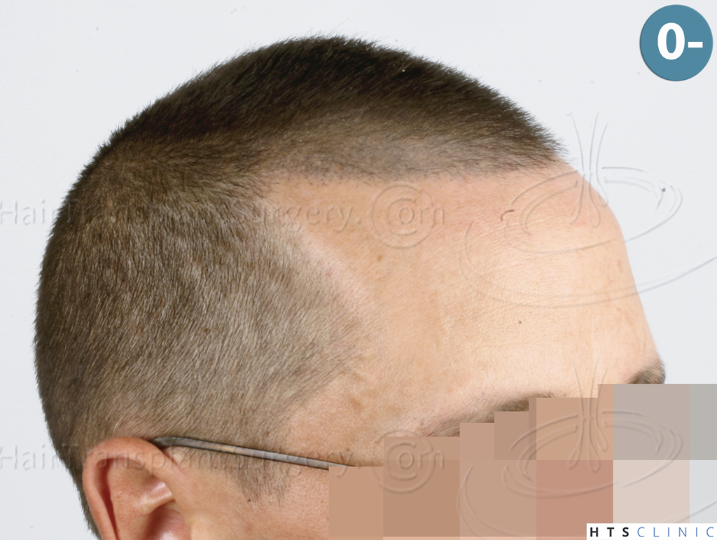 Dr.Devroye-HTS-Clinic-2950-FUE-NW-III-5.