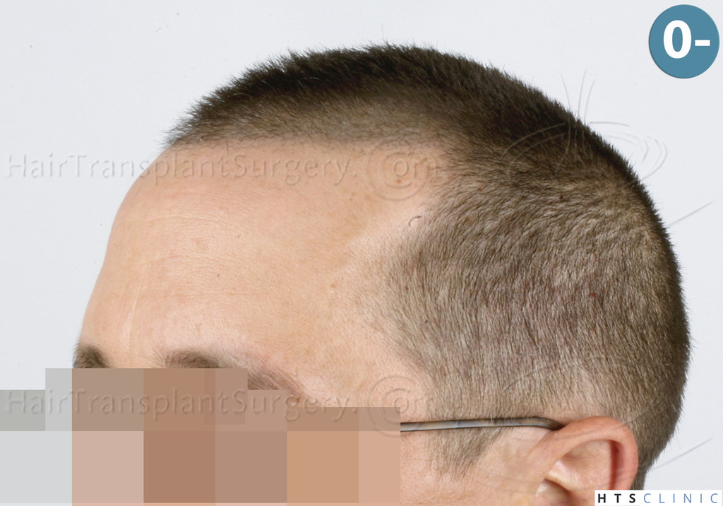 Dr.Devroye-HTS-Clinic-2950-FUE-NW-III-3.jpg