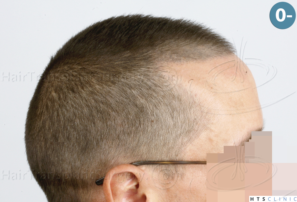 Dr.Devroye-HTS-Clinic-2950-FUE-NW-III-4